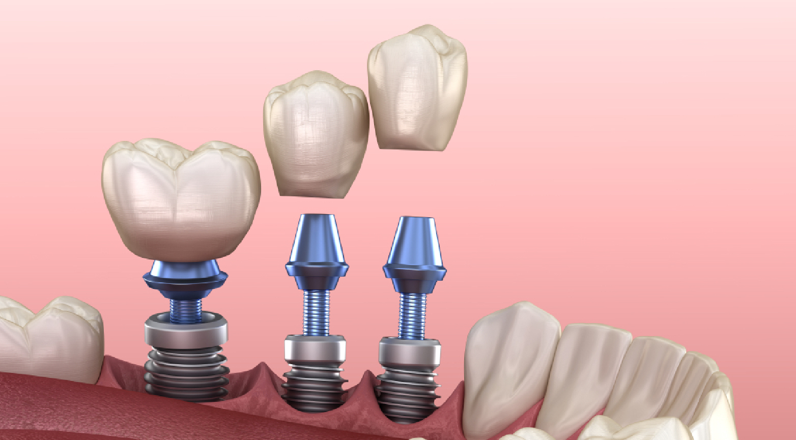 Dental Implant in Dubai