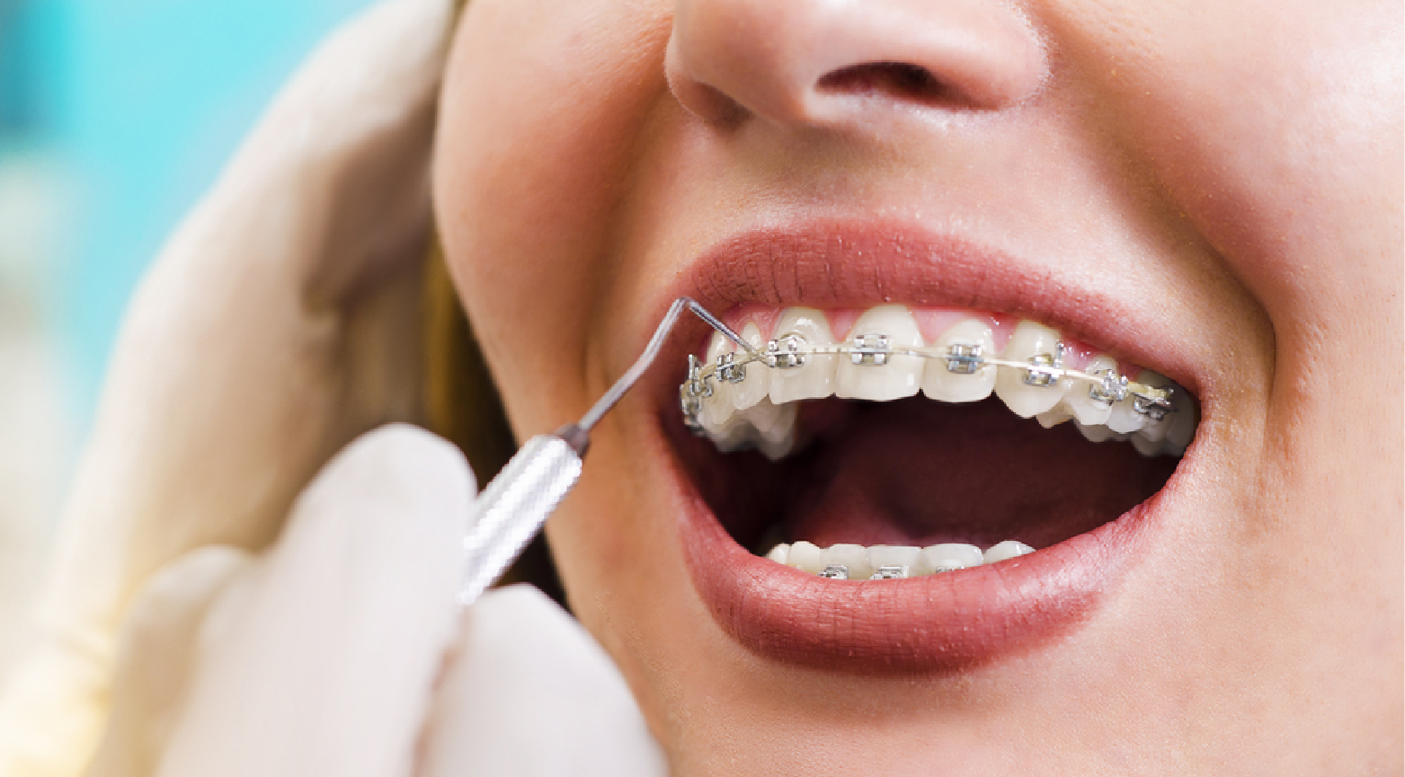 Orthodontics in Dubai