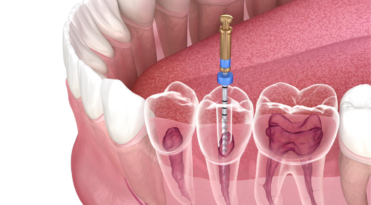 Root canal treatment in Dubai
