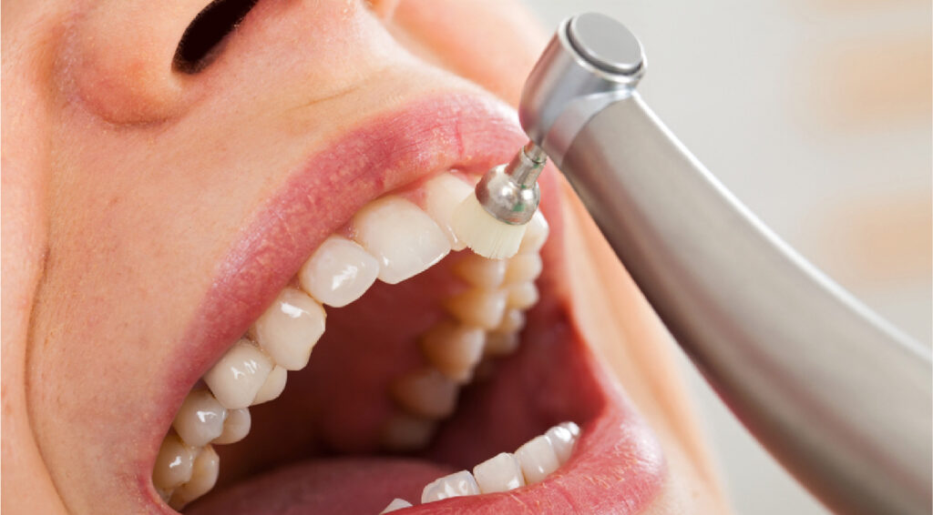 Teeth Cleaning and Gum Treatment in Dubai