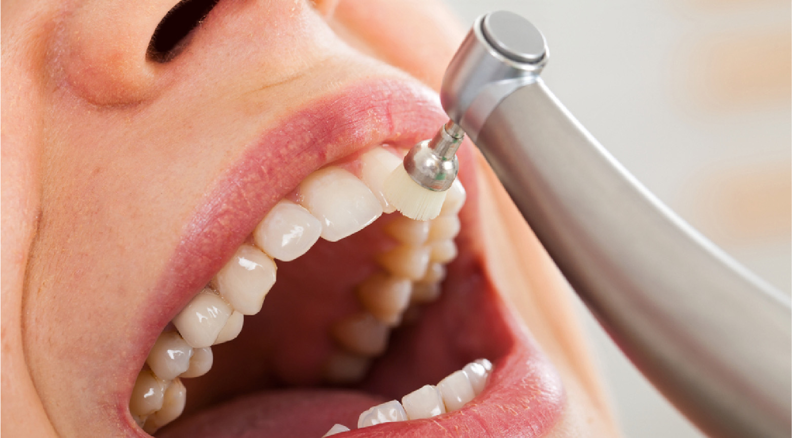 Teeth Cleaning and Gum Treatment in Dubai