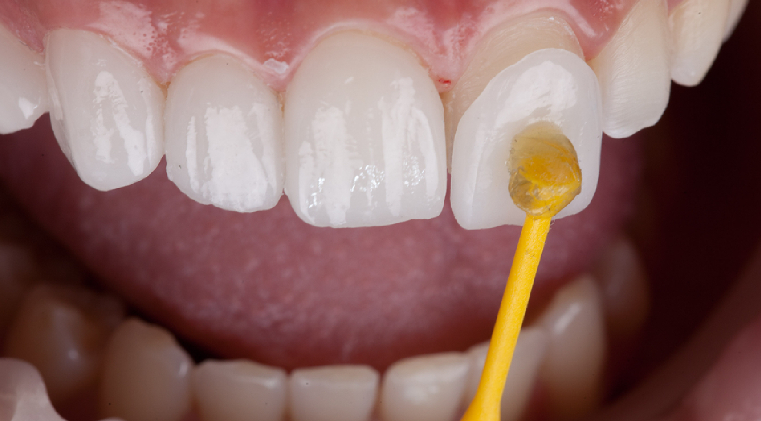 Best Veneer in Dubai