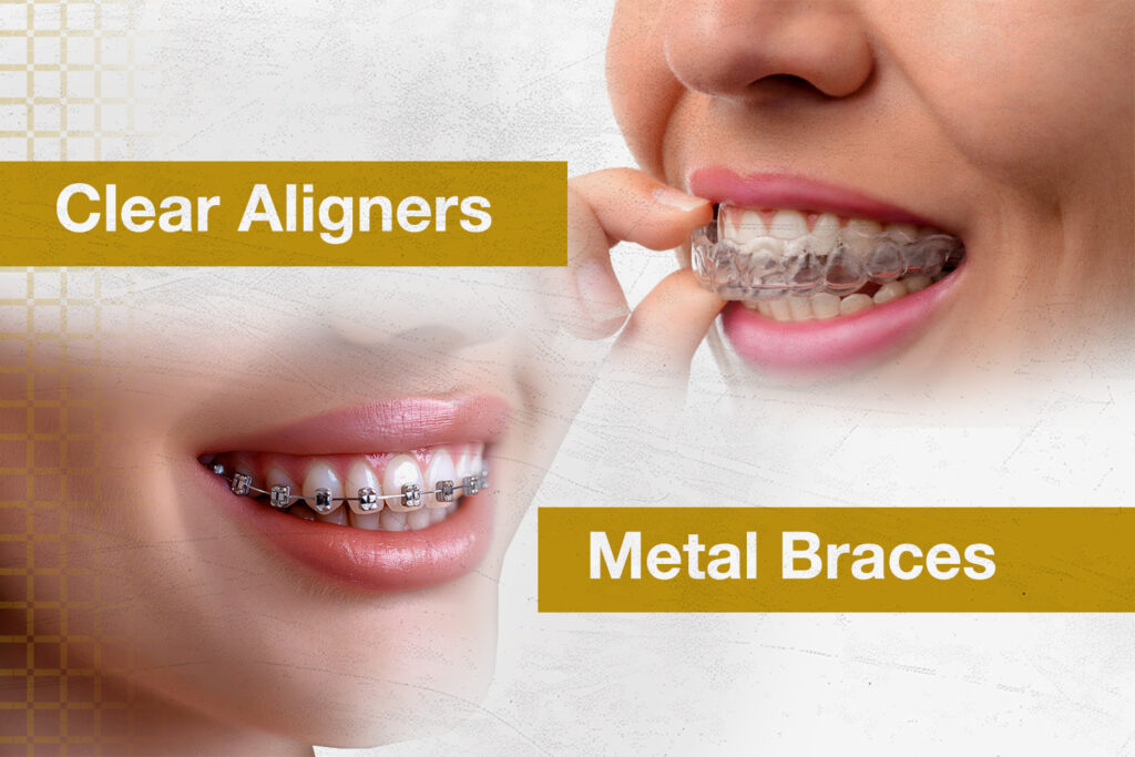 Metal Braces or Clear Aligners: Which Is Best for Your Needs?