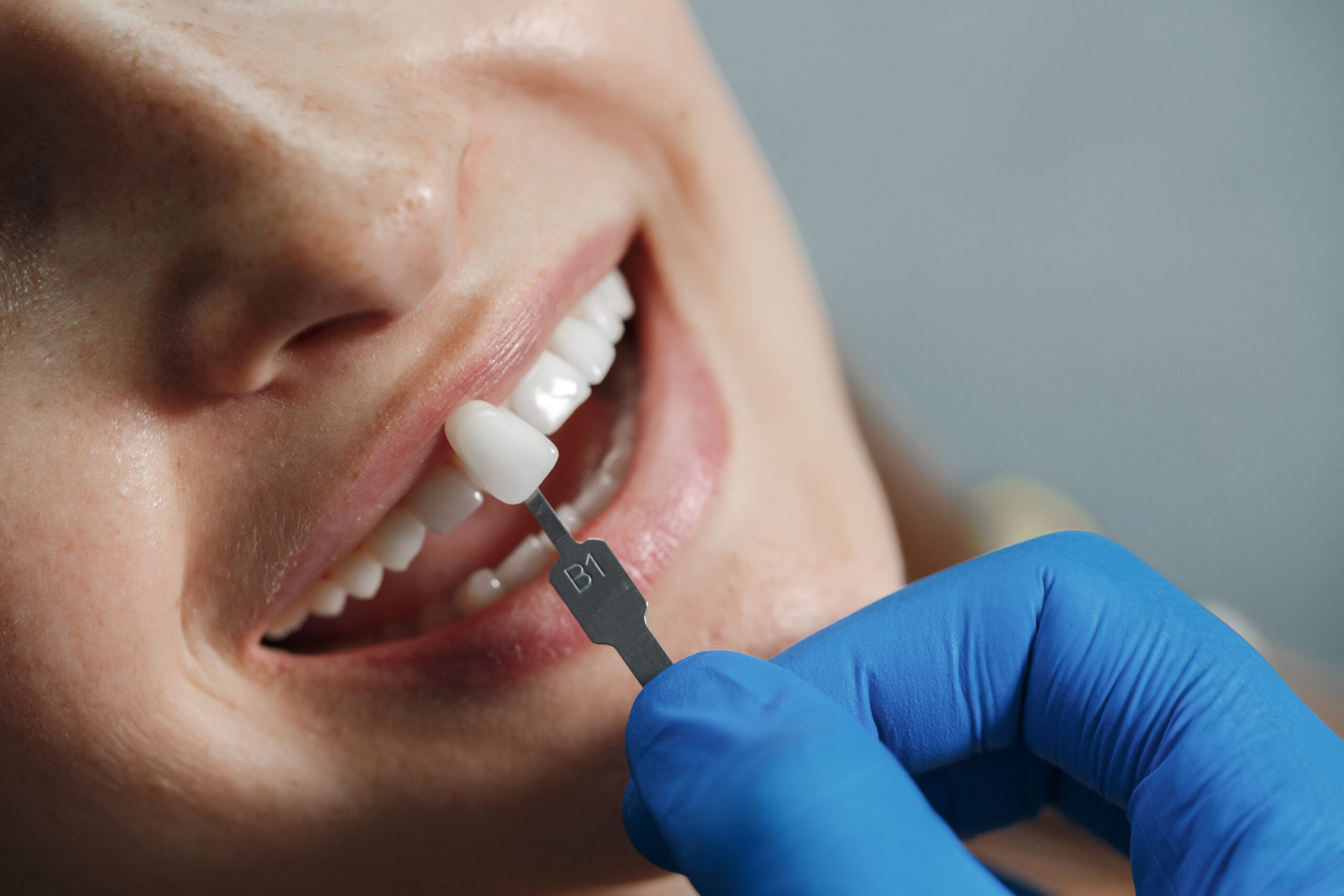 top dental implants