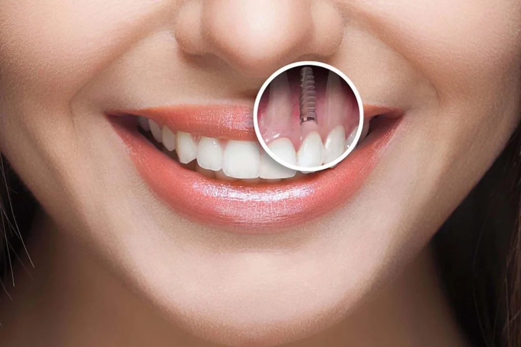 How to Find Cost-Effective Dental Implants in Dubai Without Compromising Quality